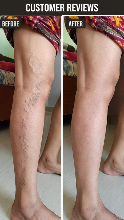 Turmeric Varicose Veins Relief Herbal Spray🌿