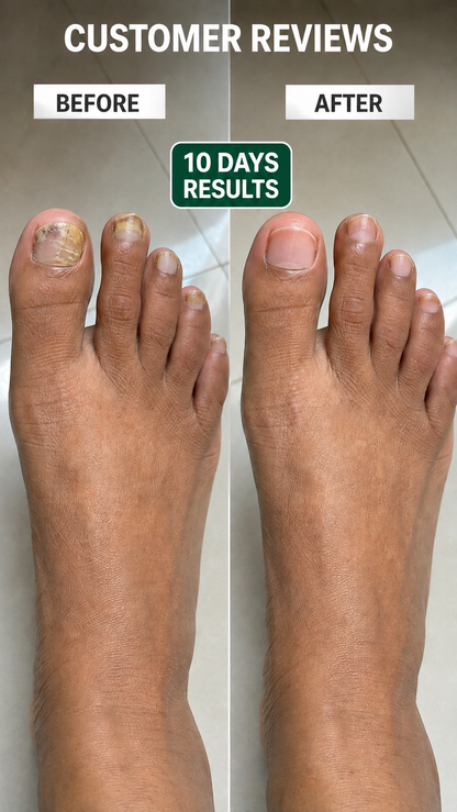 Anti Paronychia Relief Nail Oil - Buy 1 Get 1 FREE🔥
