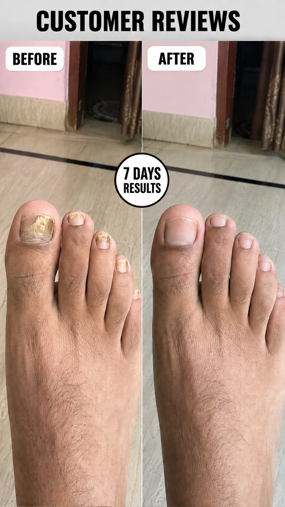 Anti Paronychia Relief Nail Oil - Buy 1 Get 1 FREE🔥