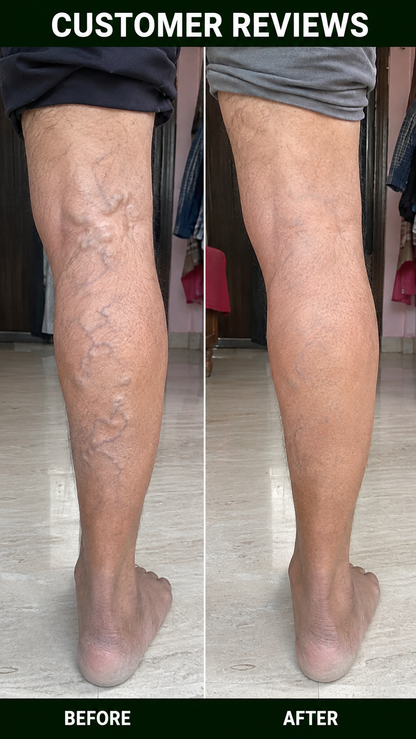 Turmeric Varicose Veins Relief Herbal Spray🌿