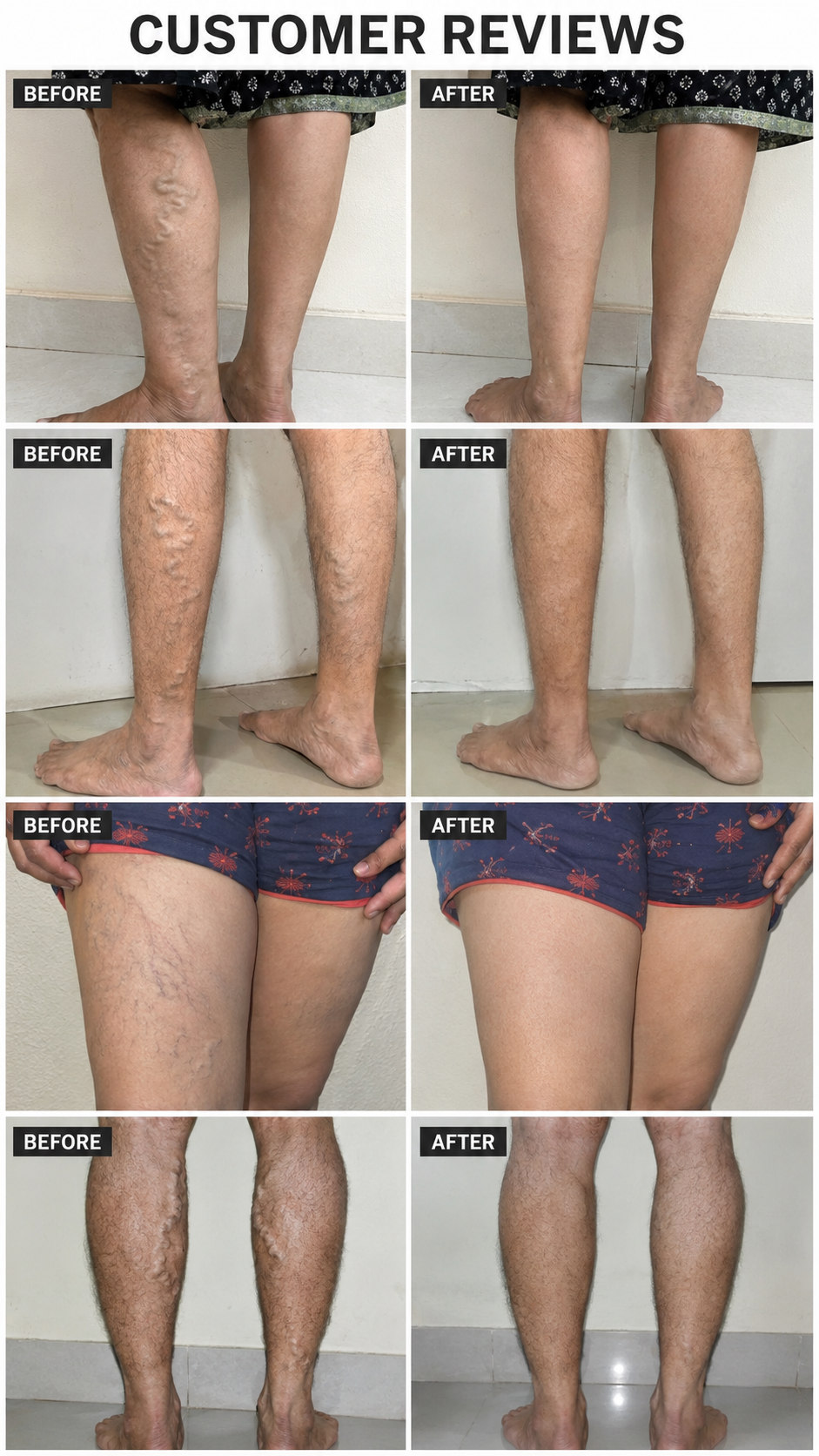 Turmeric Varicose Veins Relief Herbal Spray🌿