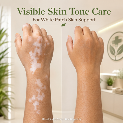 VitiGO Corrector Cream - BUY 1 GET 1 FREE 🔥