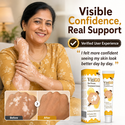 VitiGO Corrector Cream - BUY 1 GET 1 FREE 🔥
