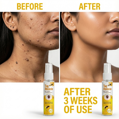 Wart & Skin Tag Remover Spray - 🔥 BUY 1 GET 1 FREE