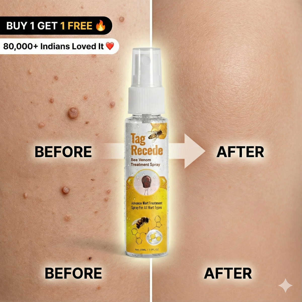 Wart & Skin Tag Remover Spray - 🔥 BUY 1 GET 1 FREE