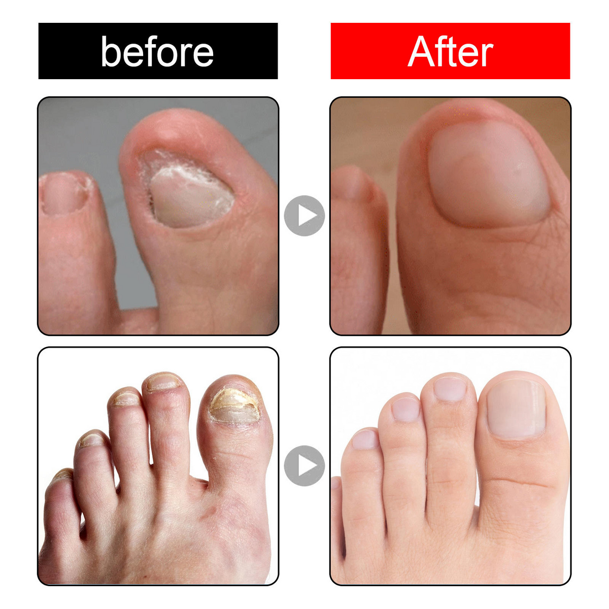 Toenail Nail Repair Oil - BUY 1 GET 1 FREE🔥🔥