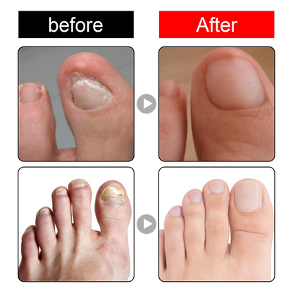 Toenail Nail Repair Oil - BUY 1 GET 1 FREE🔥🔥