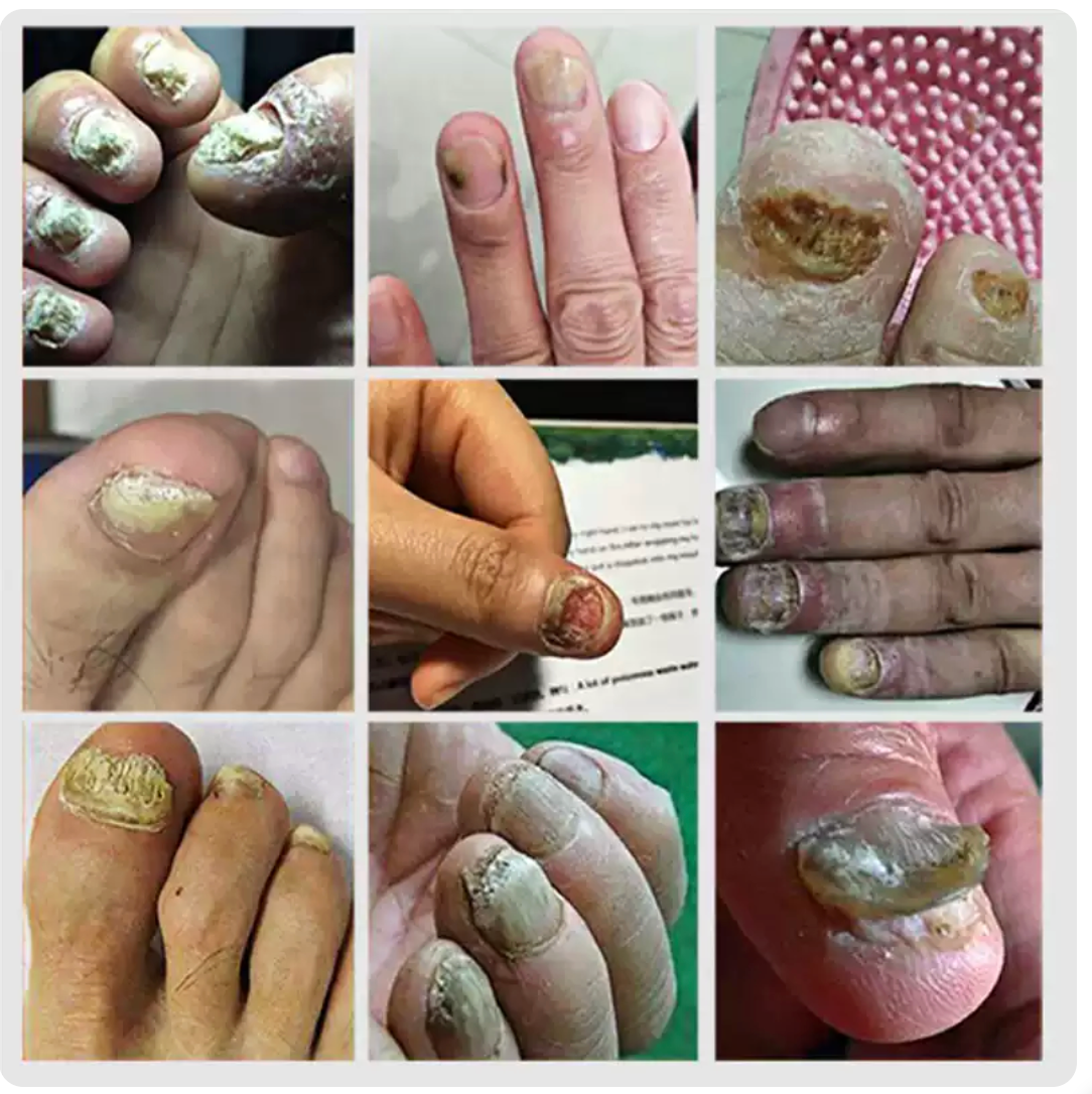 Toenail Nail Repair Oil - BUY 1 GET 1 FREE🔥🔥