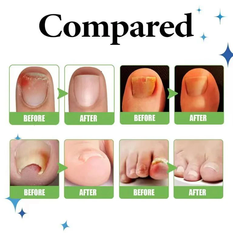 Anti Paronychia Relief Nail Oil - Buy 1 Get 1 FREE🔥