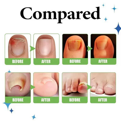 Anti Paronychia Relief Nail Oil - Buy 1 Get 1 FREE🔥