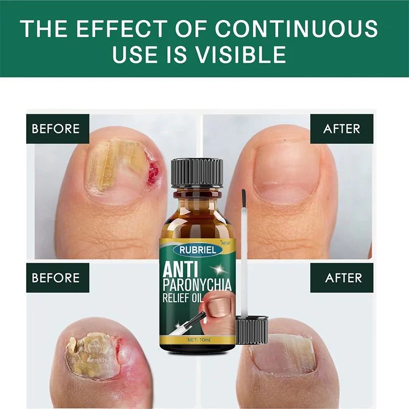 Anti Paronychia Relief Nail Oil - Buy 1 Get 1 FREE🔥