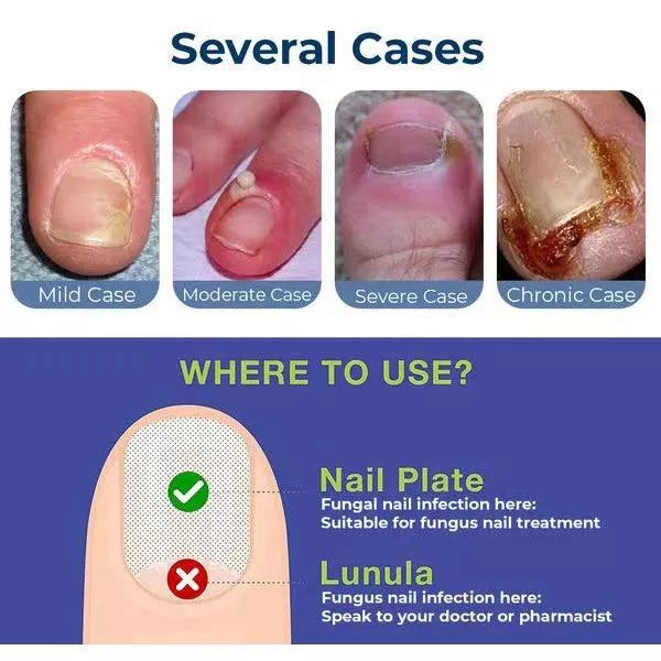 Anti Paronychia Relief Nail Oil - Buy 1 Get 1 FREE🔥