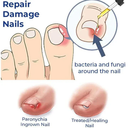 Anti Paronychia Relief Nail Oil - Buy 1 Get 1 FREE🔥