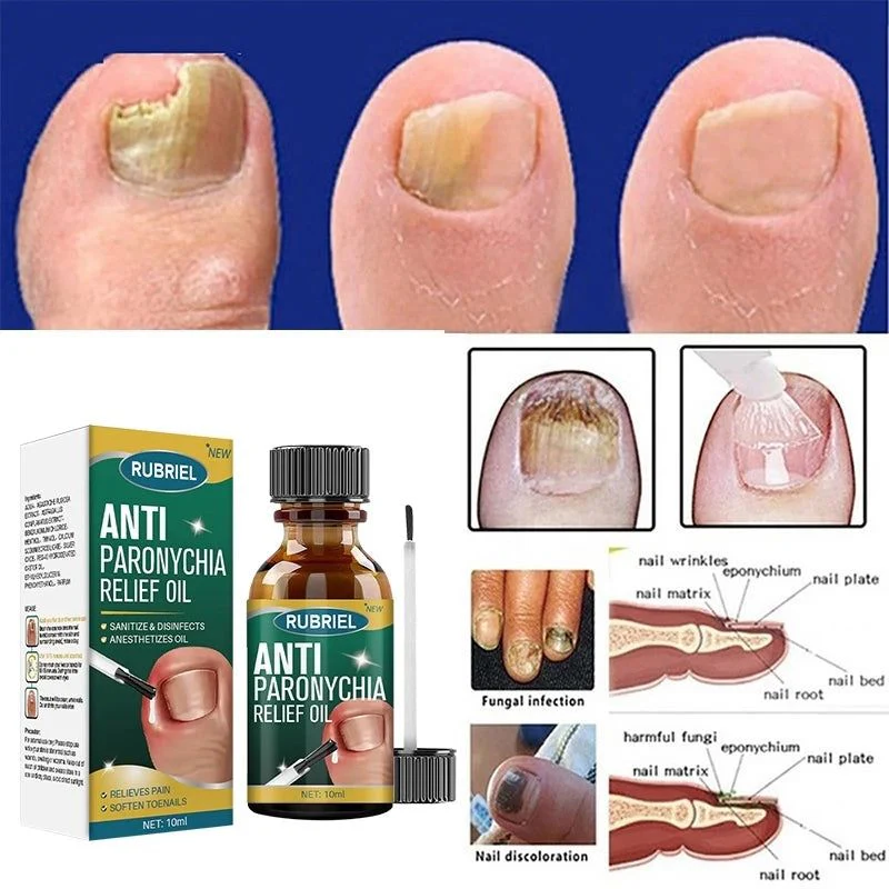 Anti Paronychia Relief Nail Oil - Buy 1 Get 1 FREE🔥