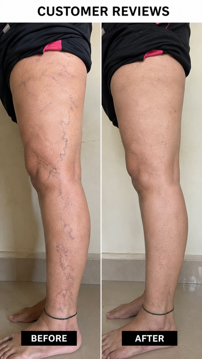 Turmeric Varicose Veins Relief Herbal Spray🌿