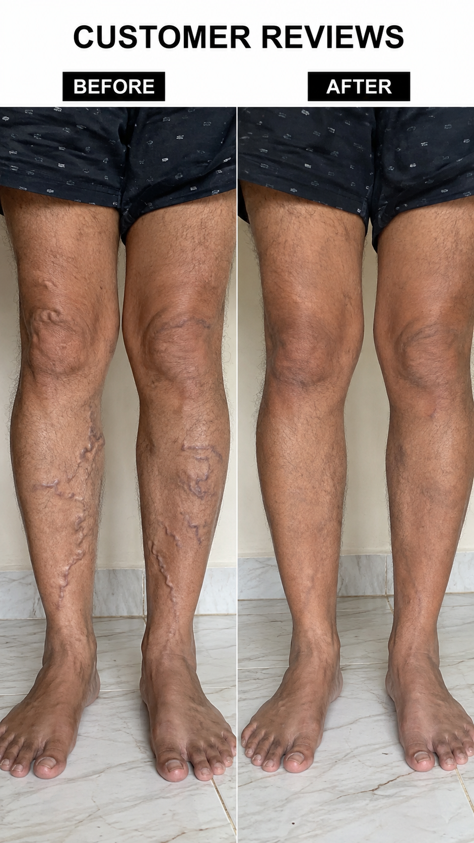 Turmeric Varicose Veins Relief Herbal Spray🌿