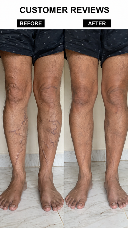 Turmeric Varicose Veins Relief Herbal Spray🌿