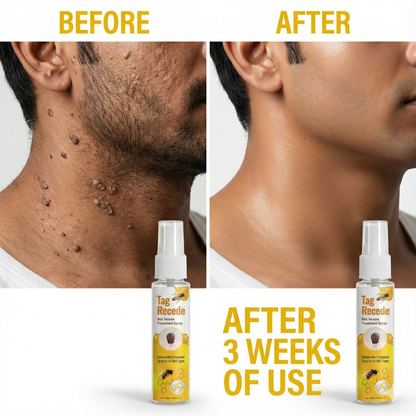 Wart & Skin Tag Remover Spray - 🔥 BUY 1 GET 1 FREE