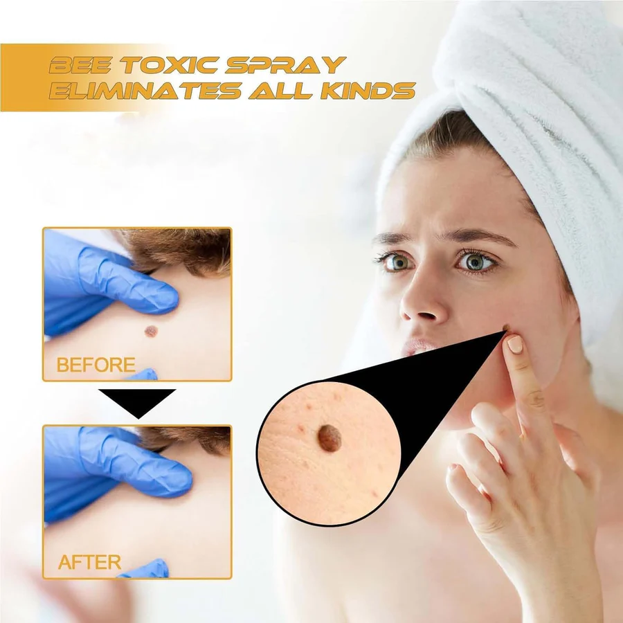 Wart & Skin Tag Remover Spray - 🔥 BUY 1 GET 1 FREE