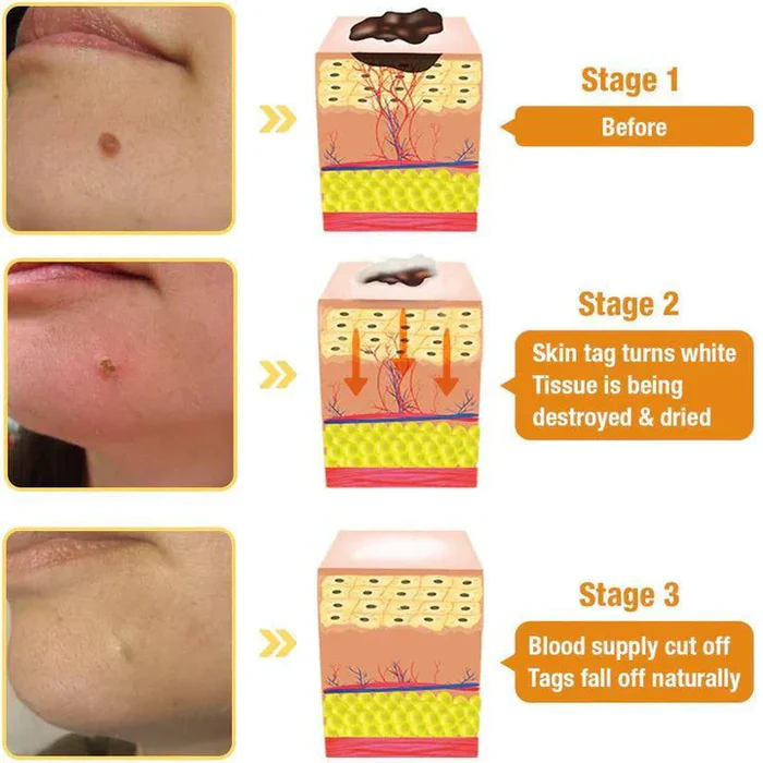 Wart & Skin Tag Remover Spray - 🔥 BUY 1 GET 1 FREE