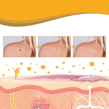 Wart & Skin Tag Remover Spray - 🔥 BUY 1 GET 1 FREE